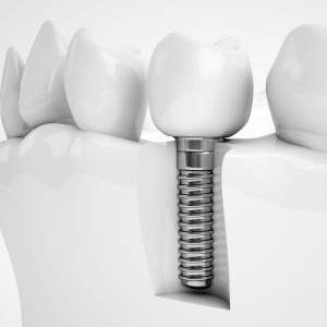 Dental Implant