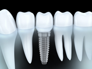 Dental Implants-What to Expect