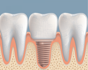 'dental implant in between standard teeth'