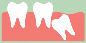 impacted wisdom tooth