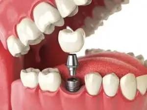 Dental Implant diagram of the implant, abutment, and crown