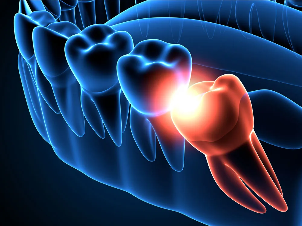 impacted wisdom tooth xray